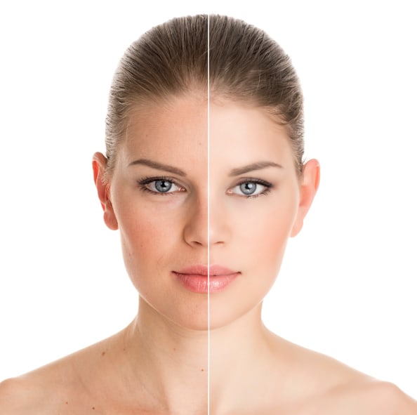 Skin Rejuvenation Laser Facial